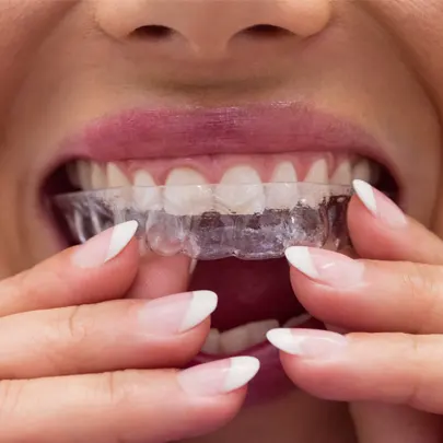 tratamiento invisalign en clínica dental