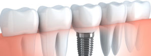 Implantes dentales en La Garriga