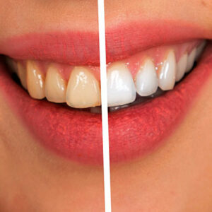 ¿Qué hacer para tener los dientes blancos sin dañarlos?