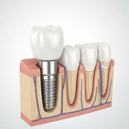 Implantes dentales: todo lo que necesitas saber